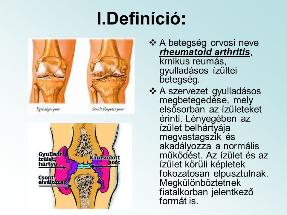 Juvenilis idiopátiás artritisz